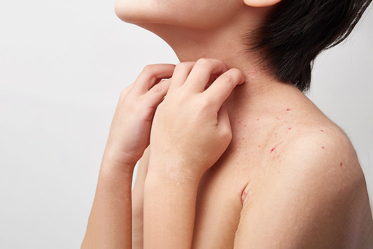 アトピー性皮膚炎のイメージ画像