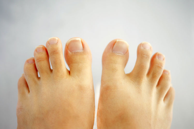 水虫のイメージ画像